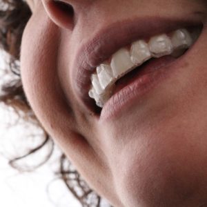 WhatsApp mulher usando Invisalign AR odontologia