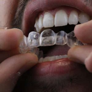 WhatsApp homem sorrindo e colocando Invisalign AR odontologia