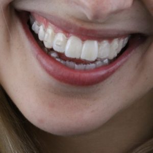 Sorrindo com Invisalign AR odontologia