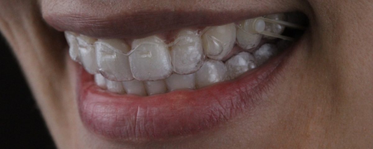 Sorrir Invisalign AR odontologia