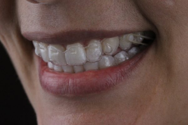 Sorrir Invisalign AR odontologia