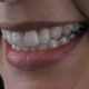 Sorrir Invisalign AR odontologia