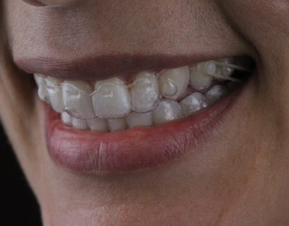 Sorrir Invisalign AR odontologia
