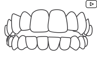 Aparelho Invisalign em BH – Dr Alysson Resende