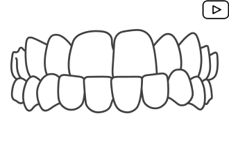 Aparelho Invisalign em BH – Dr Alysson Resende