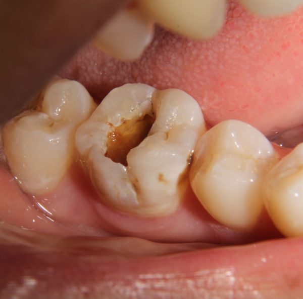 O fim do temido motorzinho do dentista