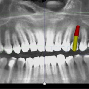 A tecnologia 3D no implante dentário