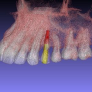 A tecnologia 3D no implante dentário