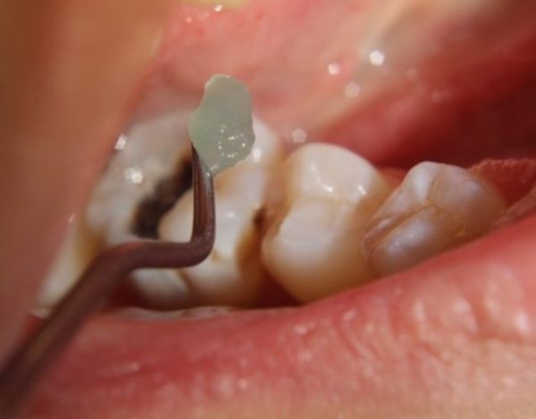 O fim do temido motorzinho do dentista