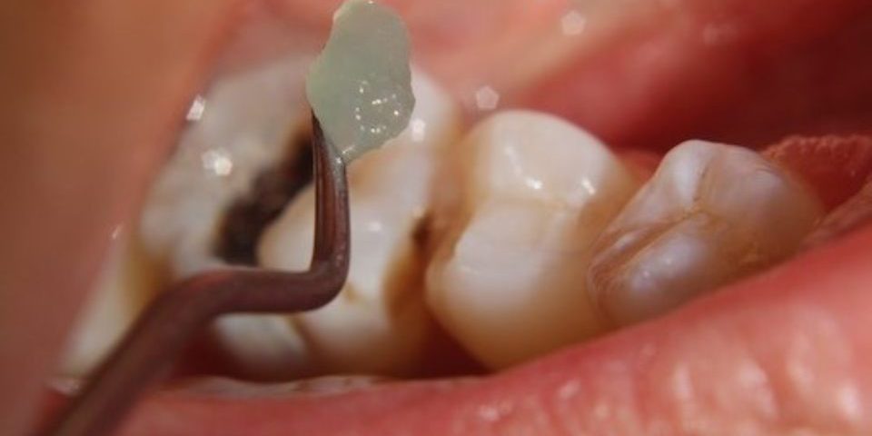 O fim do temido motorzinho do dentista