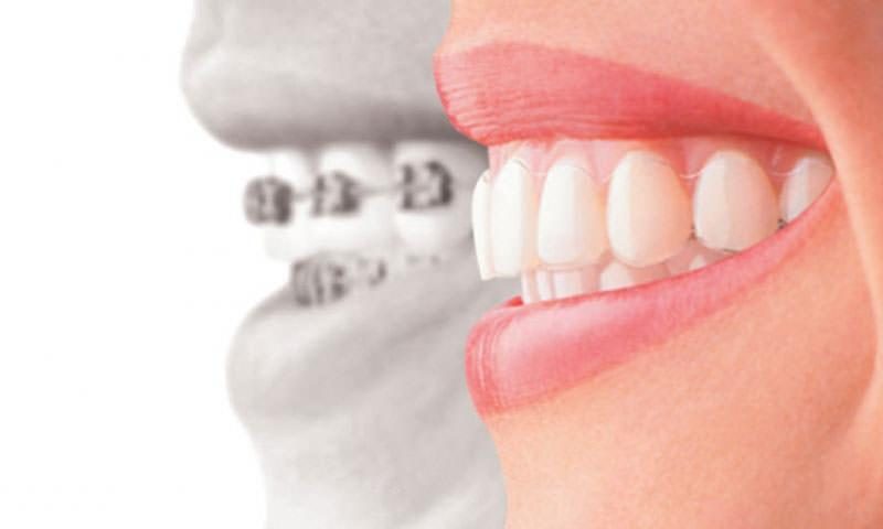 Invisalign desalinhou?