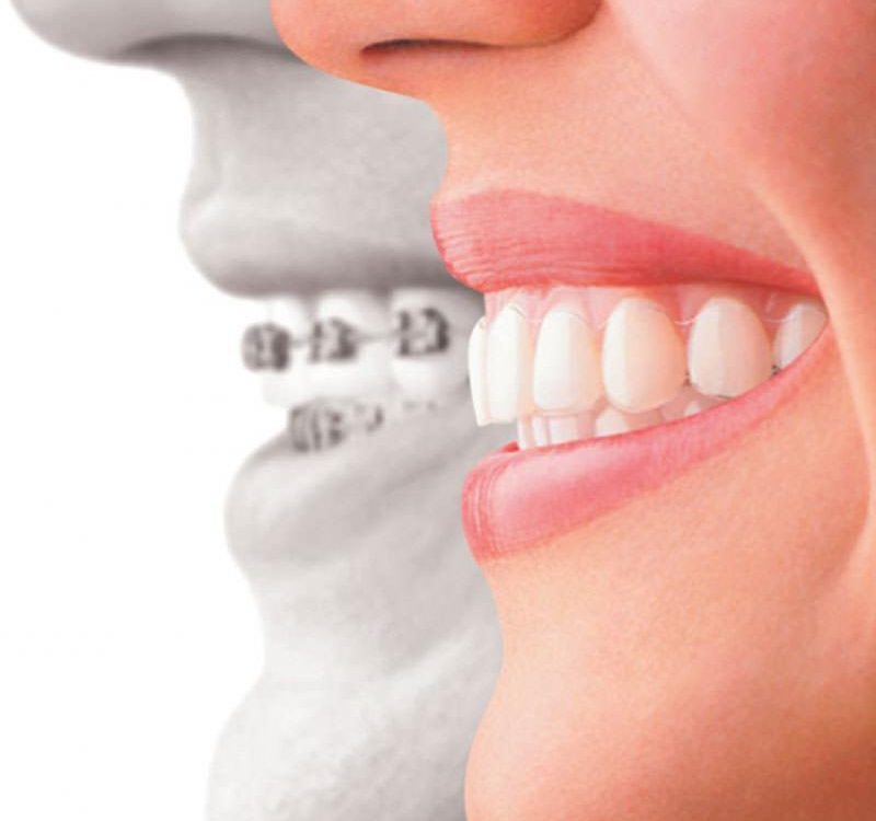 Invisalign desalinhou?
